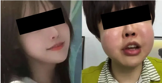 自体脂肪填充面部馒化