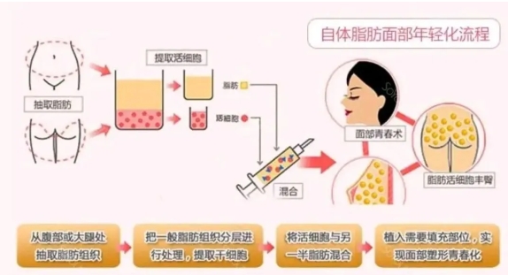 自体脂肪填充面部能维持多久