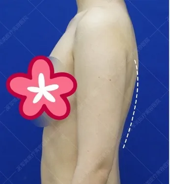 手臂吸脂变细案例