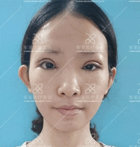 整形术后焦虑怎么缓解