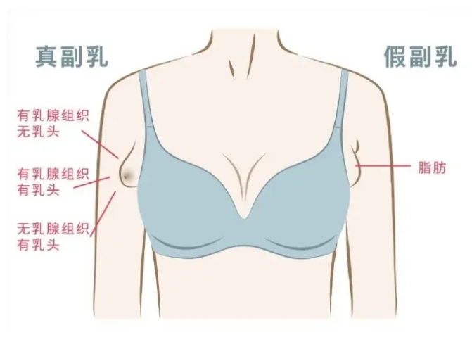 副乳怎么减掉最快