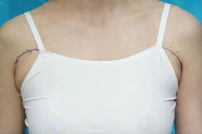 副乳吸脂好还是切除好