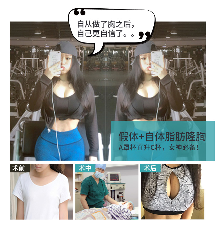 自体脂肪丰胸成功案例