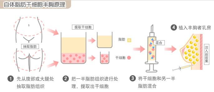 自体脂肪丰胸原理