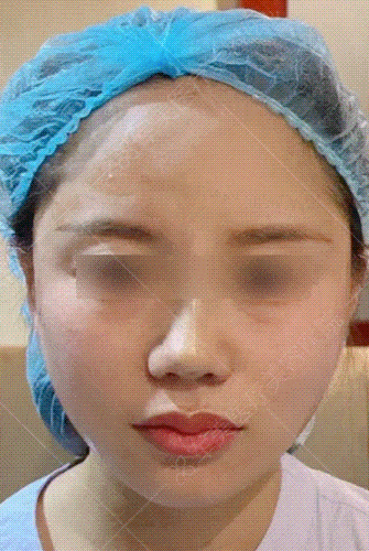 抗衰老的医美项目下面部提升