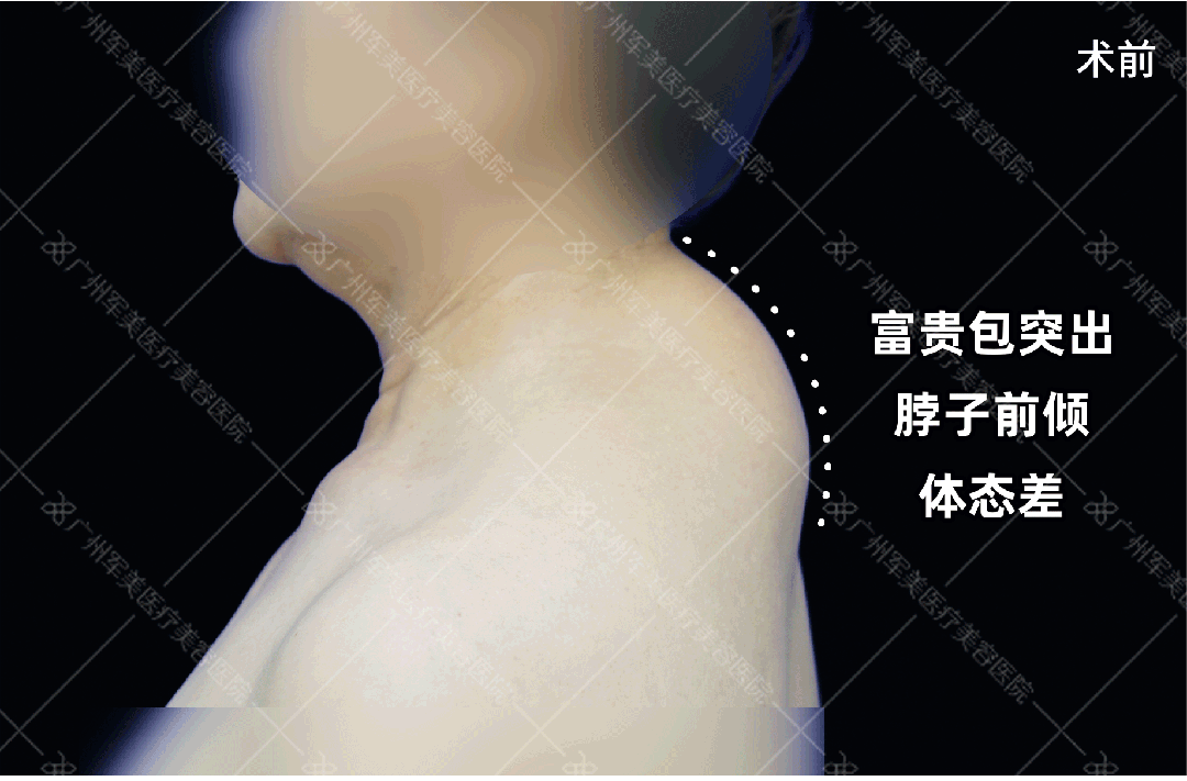 富贵包怎么消除最快方法