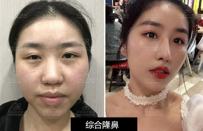 隆鼻术后多久恢复正常