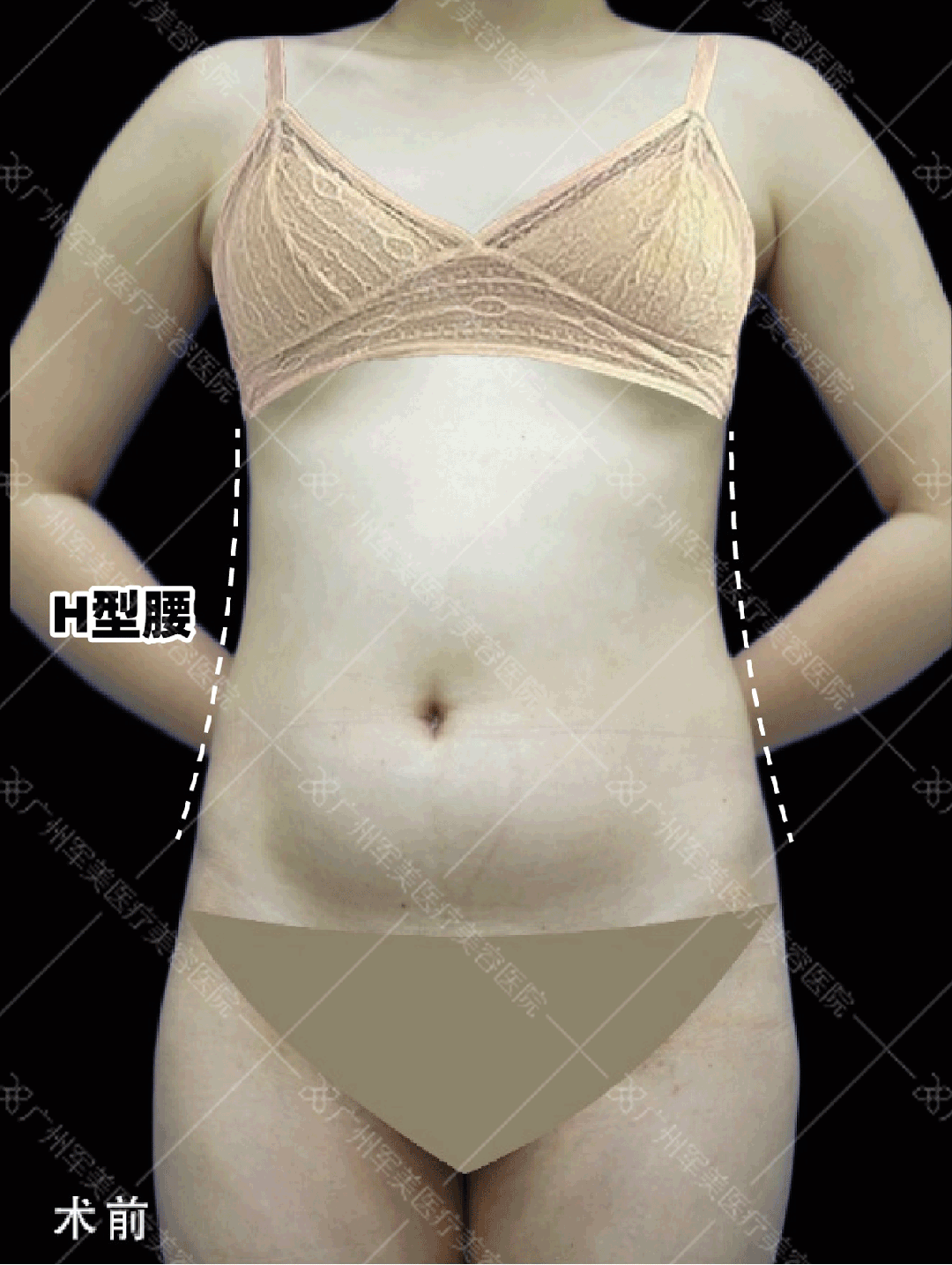 腰腹吸脂案例