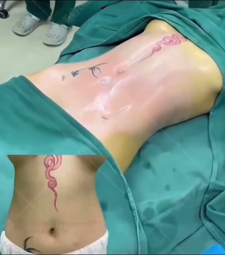 腰腹吸脂案例效果图