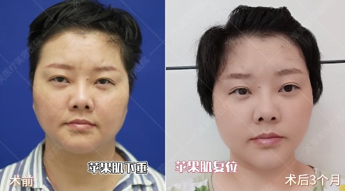面部抗衰案例