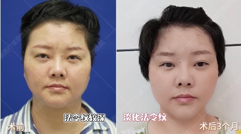 面部提升做什么项目最好