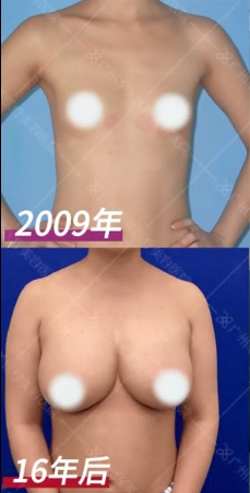 自体脂肪丰胸安全可靠吗