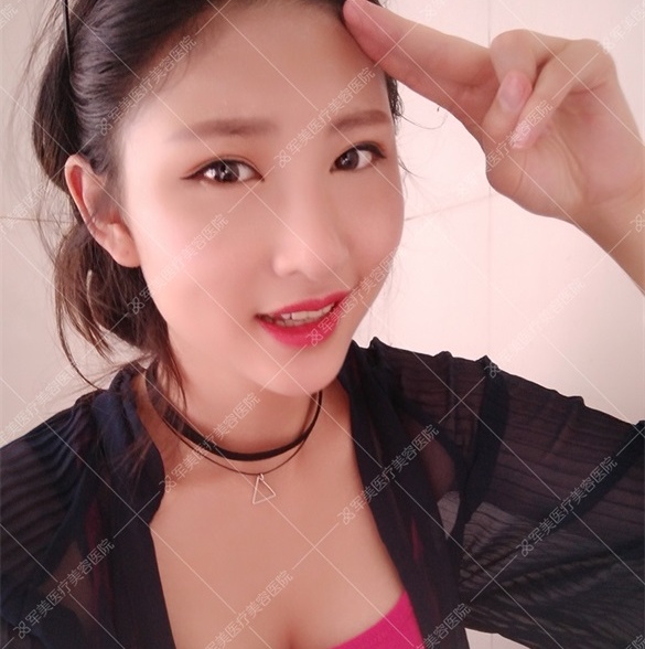 广州军美王娜案例_王娜自体脂肪隆胸怎么样？