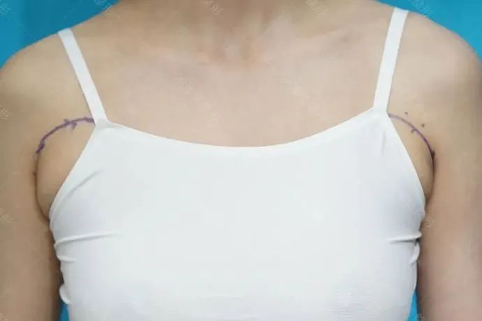 副乳吸脂案例