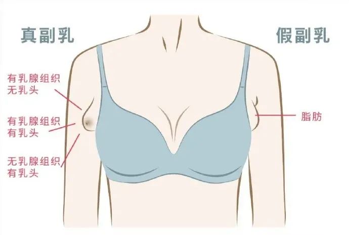 副乳吸脂好还是切除好