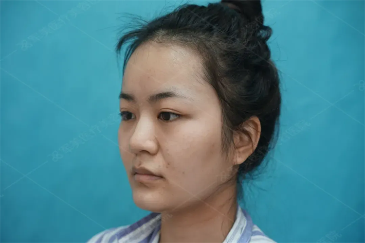 脸大怎么整成小脸案例