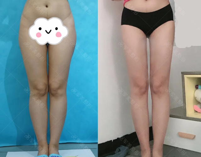大腿吸脂案例