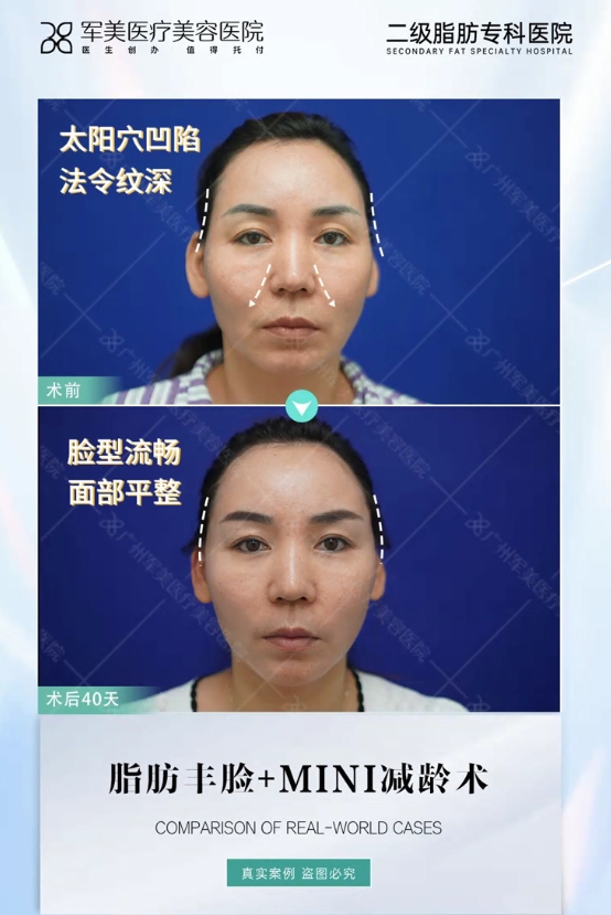 面部抗衰提升做什么项目
