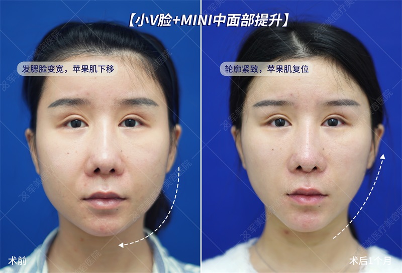 面部抗衰提升做什么项目