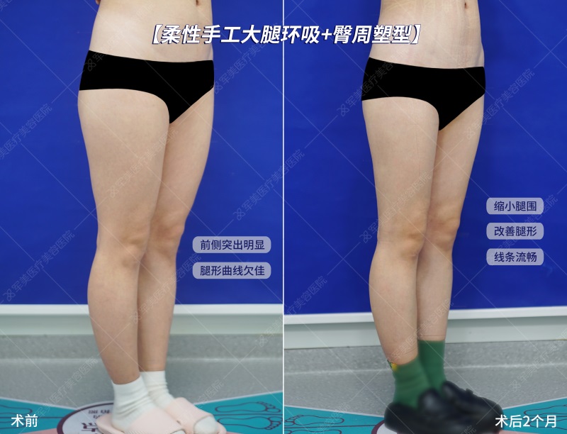 妈妈臀吸脂效果图