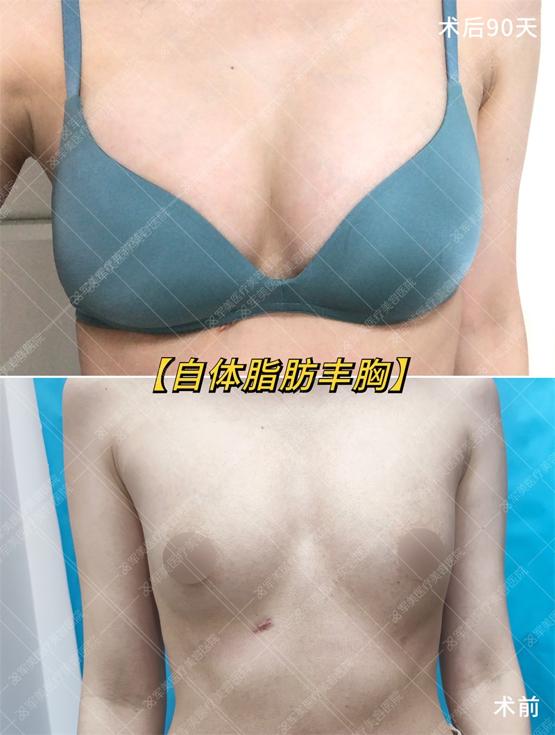 自体脂肪隆胸案例