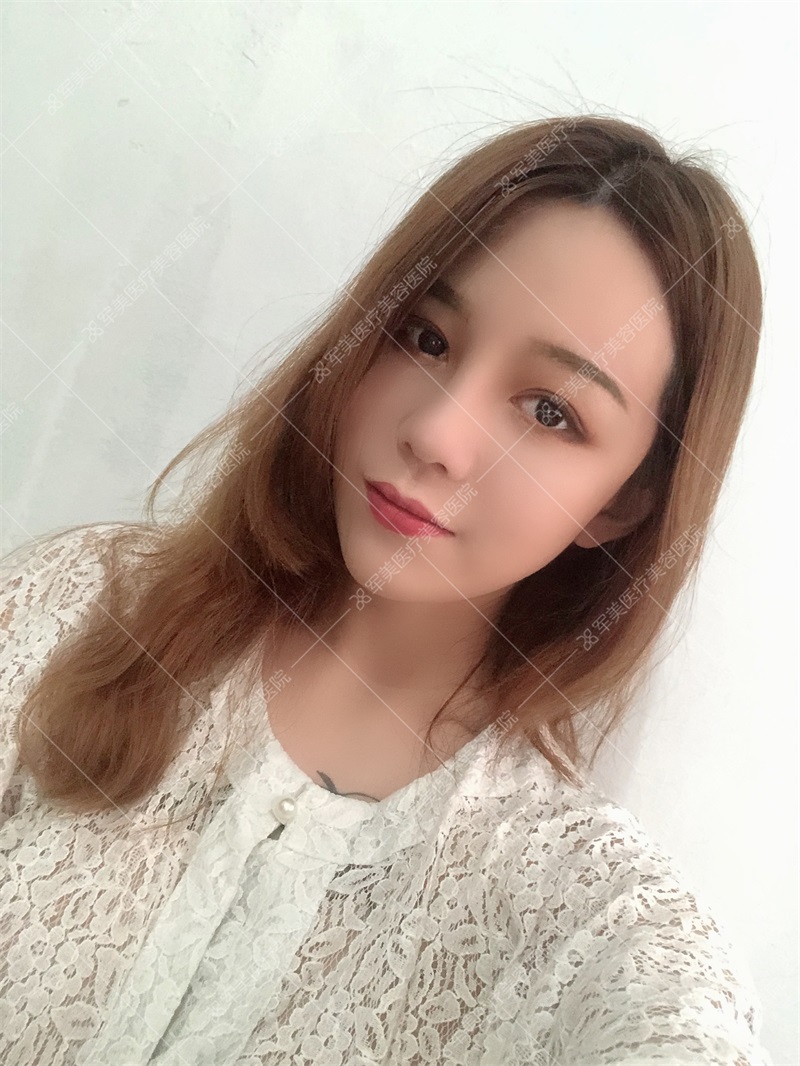 广州王世虎面部脂肪填充案例