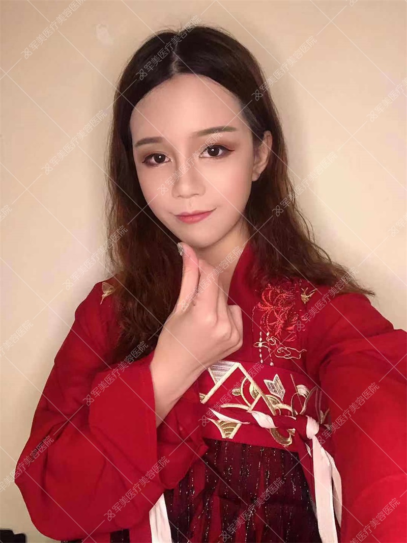 广州王世虎面部脂肪填充案例