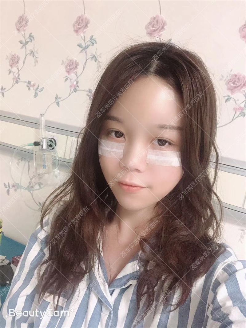 广州王世虎面部脂肪填充案例