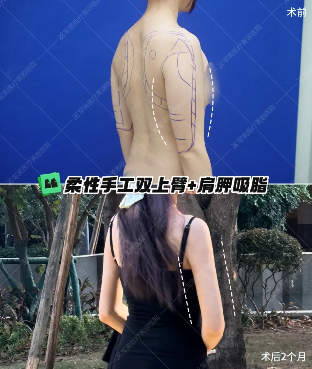 手臂吸脂术后效果图