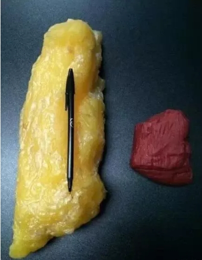 吸脂能瘦多少斤