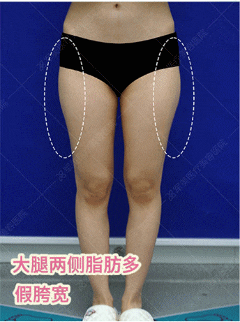 假胯宽改善案例