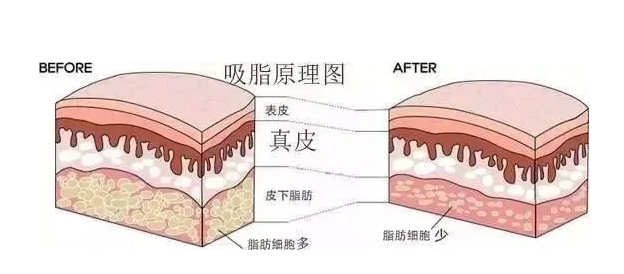 吸脂后会反弹吗