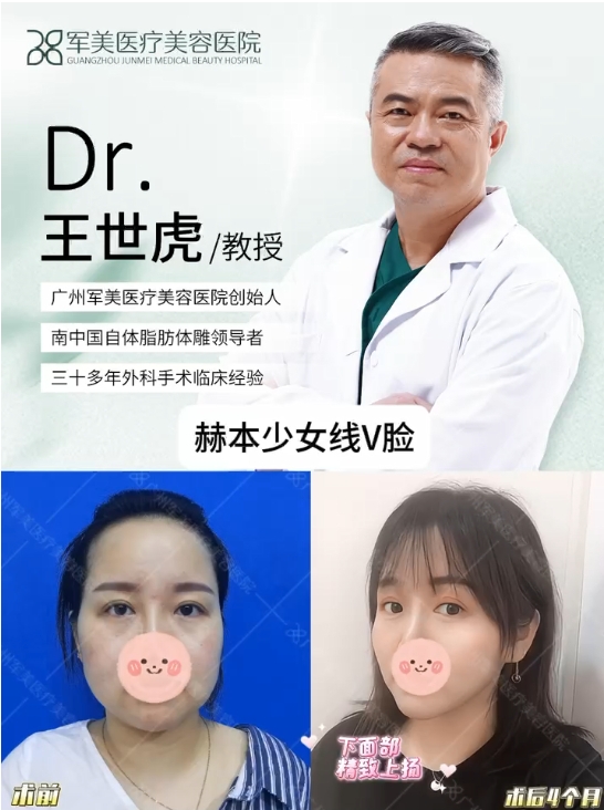 下颌线提升案例