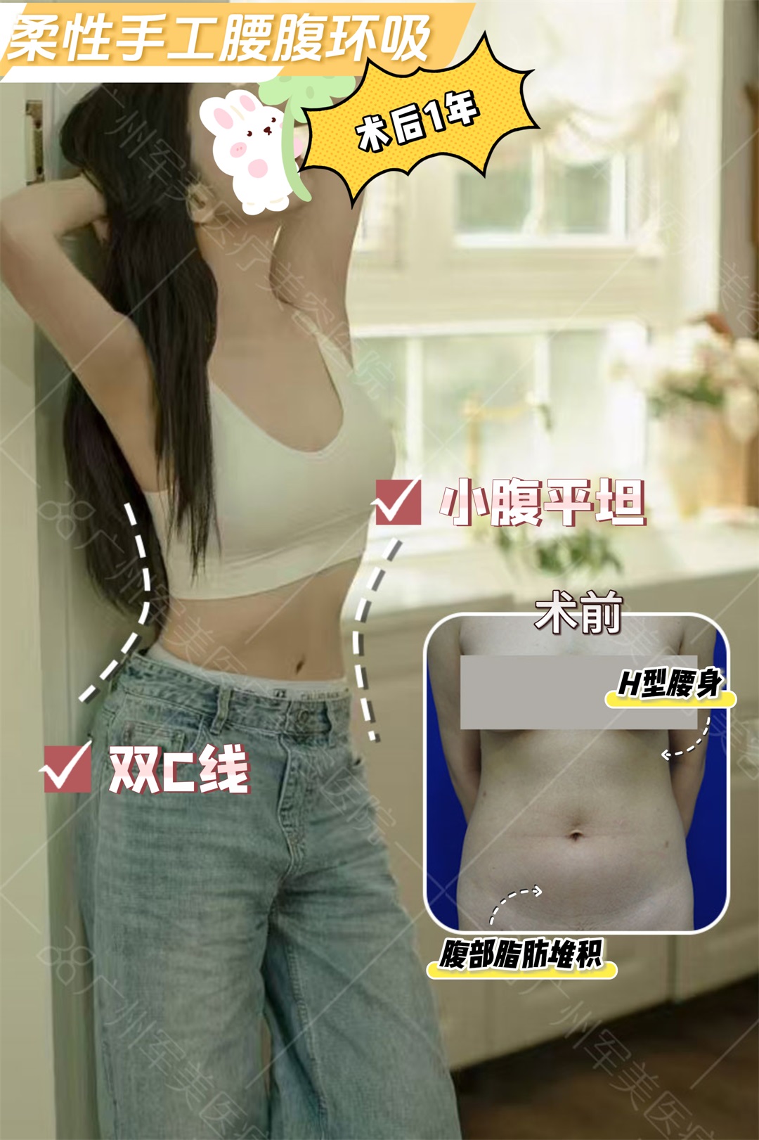 腰腹环吸案例