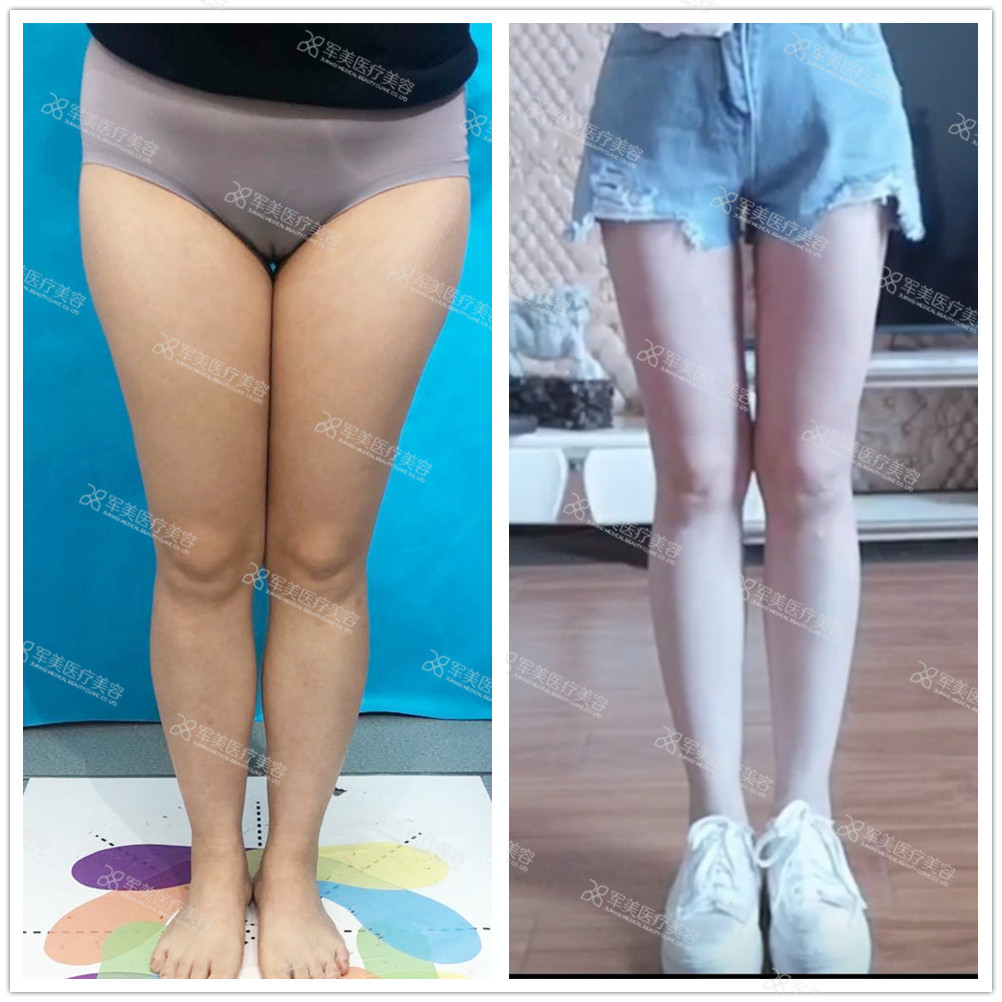 王世虎大腿吸脂案例
