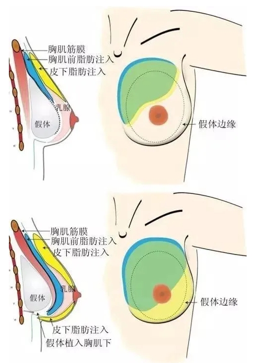 假体隆胸和自体脂肪隆胸哪个更好