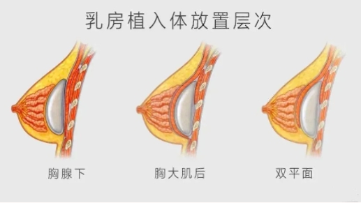 假体隆胸和自体脂肪隆胸哪个更好