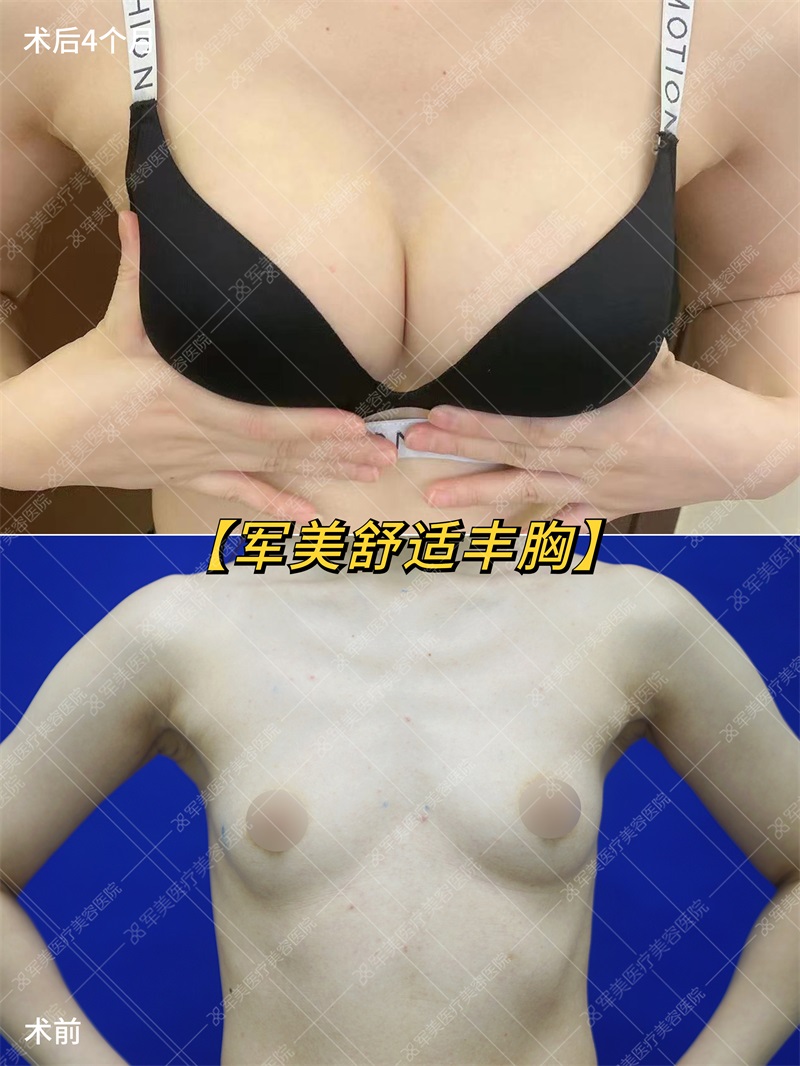 假体隆胸案例