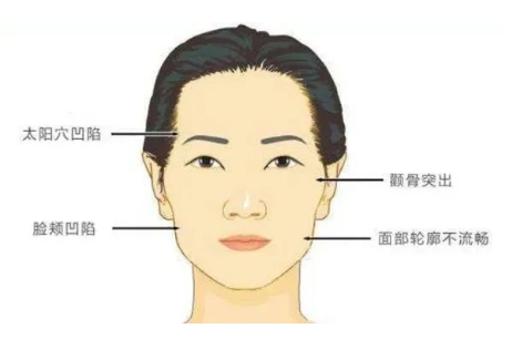 自体脂肪丰脸颊能维持多久