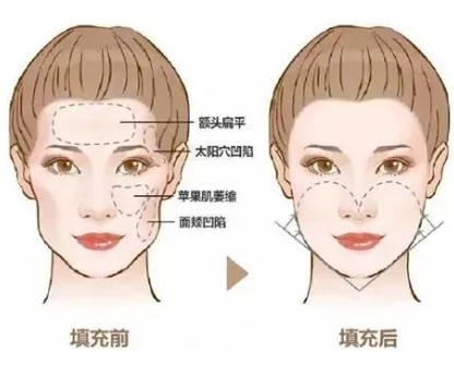 自体脂肪丰脸颊能维持多久