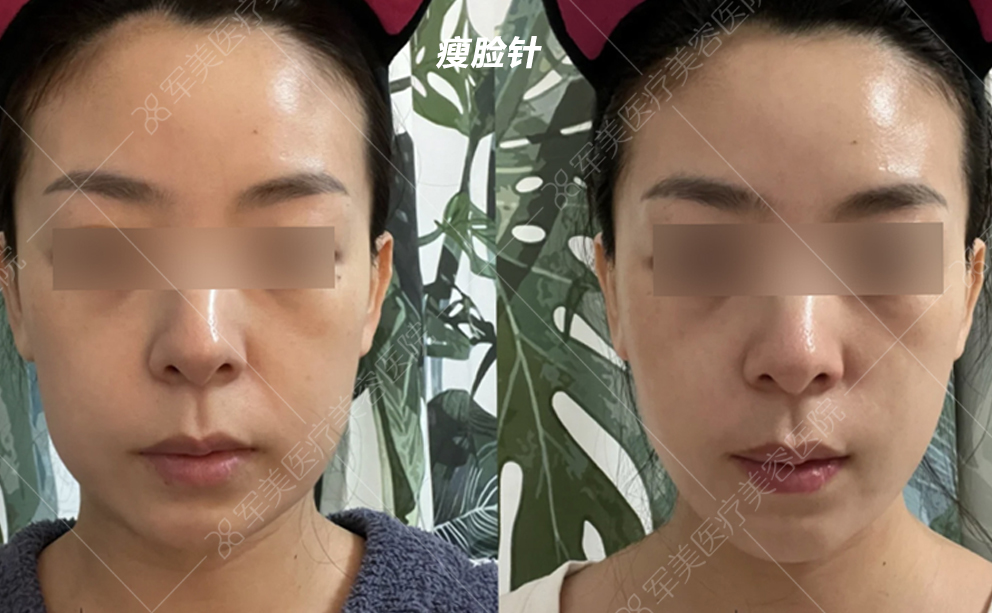 瘦脸针案例