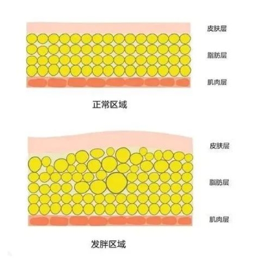 吸脂的原理