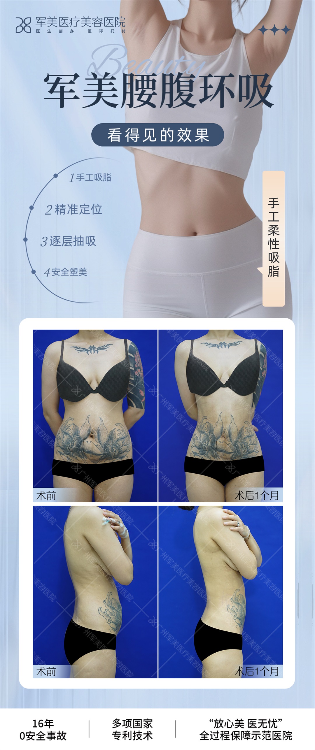 王世虎腰腹吸脂多少钱