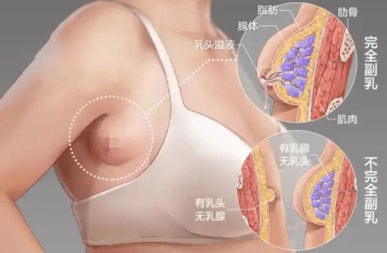 副乳是怎么来的,怎样才可以消除