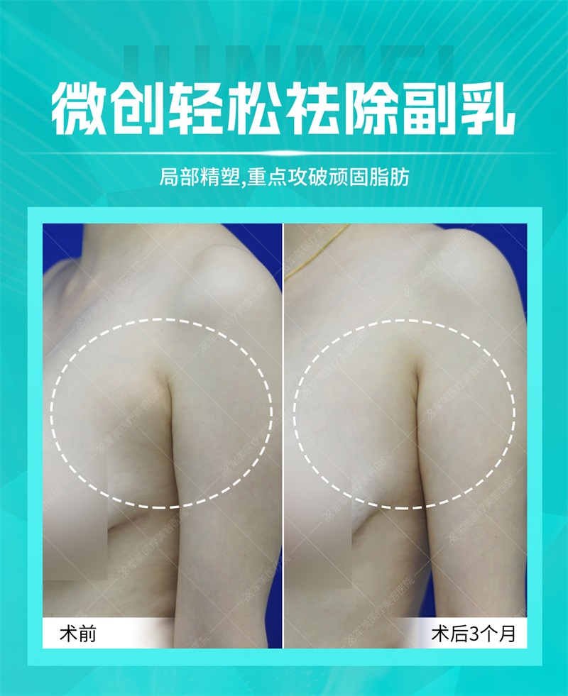 副乳是怎么来的,怎样才可以消除