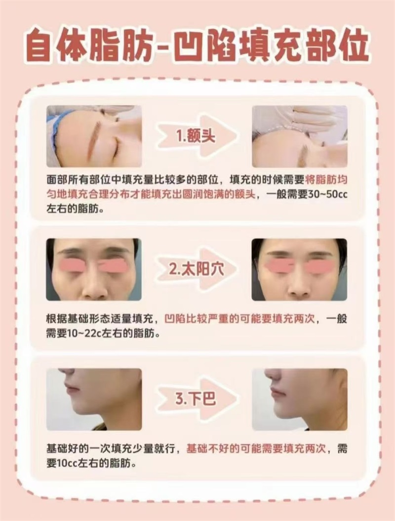 广州面部脂肪填充多少钱