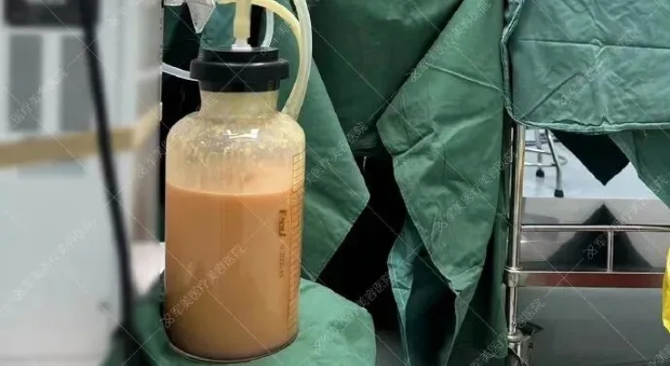 吸脂中的肿胀液图片