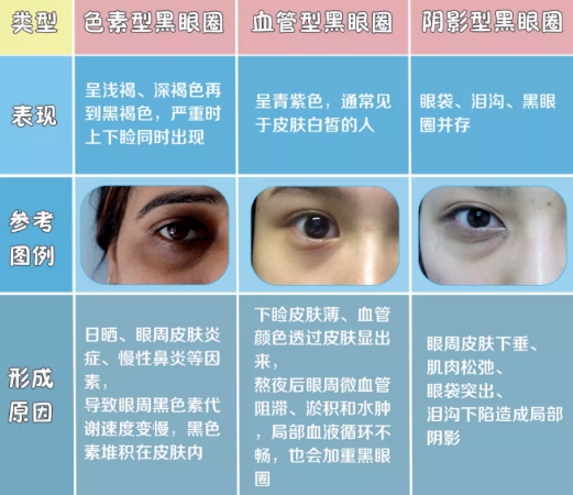 黑眼圈怎么改善