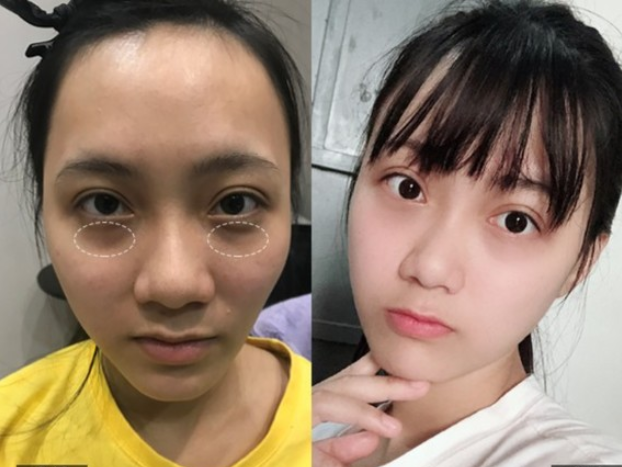 自体脂肪胶祛黑眼圈