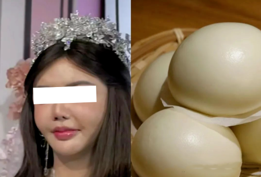 自体脂肪填充后馒化